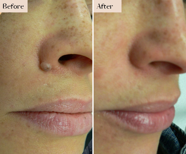 mole removal before after manhatttan nyc